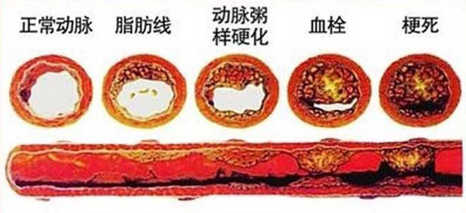 血栓在哪，病就在哪！該怎么清除血栓呢？
