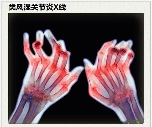 類風(fēng)濕性關(guān)節(jié)炎真的是“不死的癌癥”？