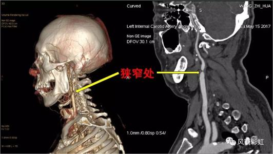 頸椎病都是“積”出來的，4個傷頸的行為，別總是做